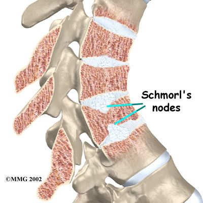 thoracic_scheuermanns_anatomy021.jpg